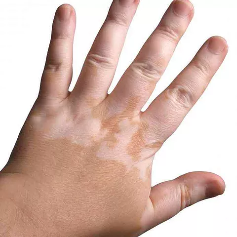 Vitiligo